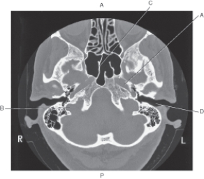 Refer to the figure below of an axial CT of the temporal bone.    -Which arrow points to the sphenoid sinus? A)  A B)  B C)  C D)  D