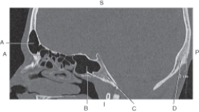 Refer to the figure below of a sagittal CT reformat of the cranium.    -Which arrow points to the occipital bone? A)  A B)  B C)  C D)  D