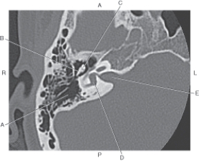 Refer to the figure below of an axial CT of the inner ear.    -Which arrow points to the incus? A)  A B)  B C)  C D)  D E)  E
