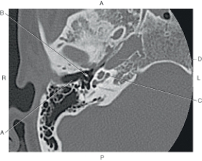Refer to the figure below of an axial CT of the inner ear.    -Which arrow points to the cochlea (basal turn) ? A)  A B)  B C)  C D)  D