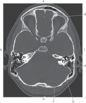 Refer to the figure below of an axial CT of the cranium.    -Which arrow points to the lambdoidal suture? A)  A B)  B C)  C D)  D