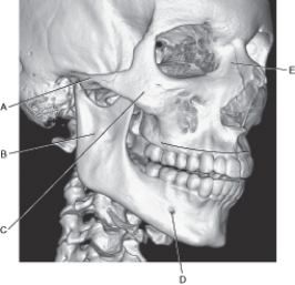 Refer to the figure below of a 3D CT of the oblique aspect of the facial bones.    -Which arrow points to the frontal process of maxilla? A)  A B)  B C)  C D)  D E)  E