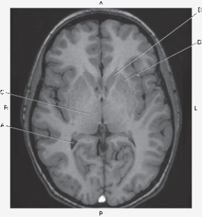 Refer to the figure below of an axial MR of the brain.    -Which arrow points to the head of the caudate nucleus? A)  A B)  B C)  C D)  D