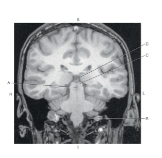 Refer to the figure below of a coronal MR of the olive and medulla oblongata.    -Which arrow points to the cerebral aqueduct? A)  A B)  B C)  C D)  D