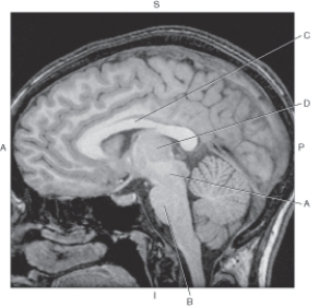 Refer to the figure below of a midsagittal MR of the brain.    -Which arrow points to the pons? A)  A B)  B C)  C D)  D