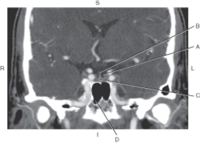 Refer to the figure below.    -Which arrow points to the pituitary gland? A)  A B)  B C)  C D)  D
