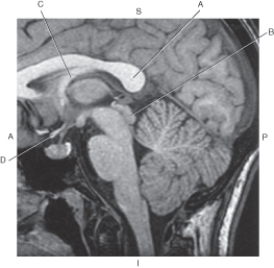 Refer to the figure below.    -Which arrow points to the quadrigeminal plate? A)  A B)  B C)  C D)  D