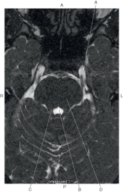 Refer to the figure below.    -Which arrow points to the superior cerebellar peduncle? A)  A B)  B C)  C D)  D