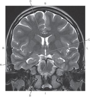<strong>Questions 33 through 36 refer to the figure below of a coronal, T2-weighted MRI of the brain. Which arrow points to the third ventricle?</strong> A) A B) B C) C D) D