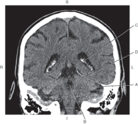 Refer to the figure below of a coronal CT reformat of the brain.    -Which arrow points to tentorium cerebelli? A)  A B)  B C)  C D)  D