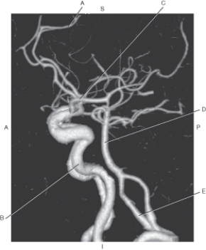 <strong>Questions 41 through 45 refer to the figure below of a lateral CTA of cerebral arteries. Which arrow points to the middle cerebral artery?</strong> A) A B) B C) C D) D E) E