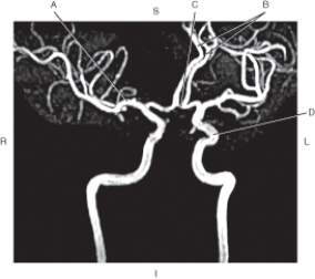 <strong>Questions 46 through 49 refer to the figure below of a coronal oblique MRA of cerebral arteries. Which arrow points to the anterior cerebral artery?</strong> A) A B) B C) C D) D