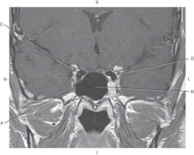 <strong>Questions 50 through 53 refer to the figure below of a coronal T1-weighted MRI of the cavernous sinus with contrast enhancement. Which arrow points to the sphenoid sinus?</strong> A) A B) B C) C D) D