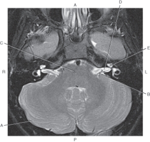 <strong>Questions 54 through 58 refer to the figure below of an axial T2-weighted MRI of the brain. Which arrow points to the cochlea?</strong> A) A B) B C) C D) D E) E