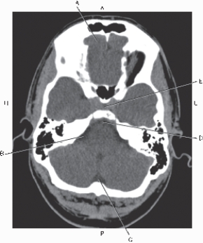 Question refer to the figure below of an axial CT of the brain.    -Which arrow points to the basilar artery in the sella turcica? A)  A B)  B C)  C D)  D E)  E