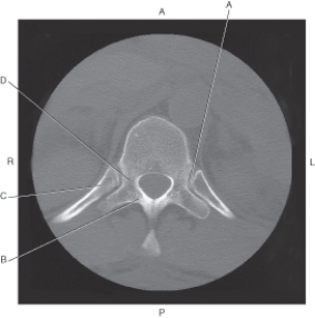 Refer to the figure below of an axial CT of the thoracic vertebra.    -Which arrow points to the pedicle? A)  A B)  B C)  C D)  D
