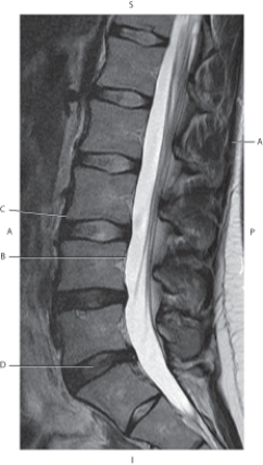 <strong>Questions 9 through 11 refer to the figure below of a sagittal MR of the lumbar spine. Which arrow points to the conus medullaris?</strong> A) A B) B C) C D) D