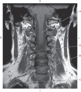 Refer to the figure below.    -Which arrow points to the right subclavian artery? A)  A B)  B C)  C D)  D