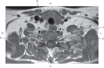Refer to the figure below.    -Which arrow points to the esophagus? A)  A B)  B C)  C D)  D