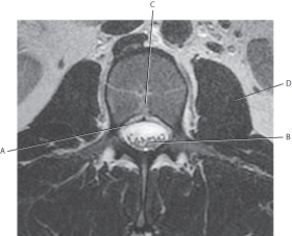<strong>Questions 20 through 23 refer to the figure below of an axial, T2-weighted MRI of the lumbar vertebra. Which arrow points to the thecal sac?</strong> A) A B) B C) C D) D
