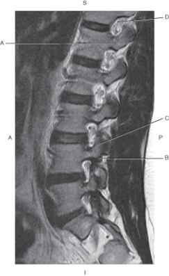 <strong>Questions 24 through 27 refer to the figure below of a sagittal, T2-weighted MRI of the lumbar vertebra. Which arrow points to the intervertebral foramen?</strong> A) A B) B C) C D) D