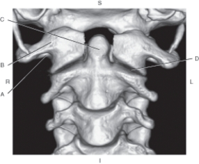 <strong>Questions 28 through 31 refer to the figure below of a 3D CT of the cervical vertebrae, anterior view. Which arrow points to the transverse foramen of C1?</strong> A) A B) B C) C D) D