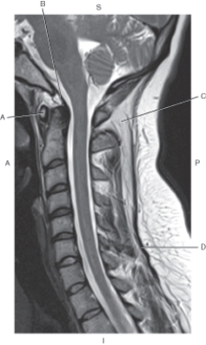 Refer to the figure below of a midsagittal, T2-weighted MRI of the cervical spine with spinal ligaments.    -Which arrow points to the tectorial membrane? A)  A B)  B C)  C D)  D