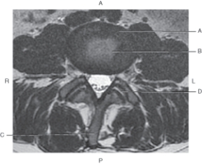 <strong>Questions 36 through 39 refer to the figure below of an axial, T2-weighted MRI of the lumbar spine with intervertebral disk and zygapophyseal joints. Which arrow points to the nucleus pulposus?</strong> A) A B) B C) C D) D