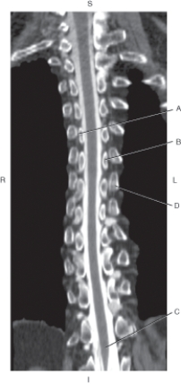 Refer to the figure below of a coronal CT reformat of the thoracic spine, post myelogram.    -Which arrow points to the costotransverse joint? A)  A B)  B C)  C D)  D