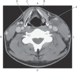 In the figure below of an axial CT of the neck with thyroid cartilage,which arrow points to the thyroid cartilage?   A)  A B)  B C)  C D)  D