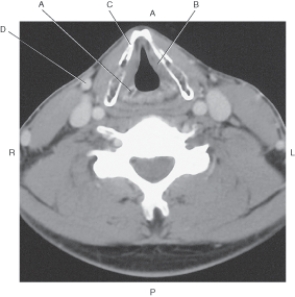 In the figure below of an axial CT of the larynx with vocal cords and arytenoid cartilages,which arrow points to the arytenoid cartilage?   A)  A B)  B C)  C D)  D