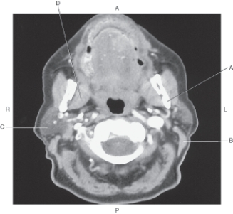 In the figure below of an axial CT of the neck,which arrow points to the parotid gland?   A)  A B)  B C)  C D)  D