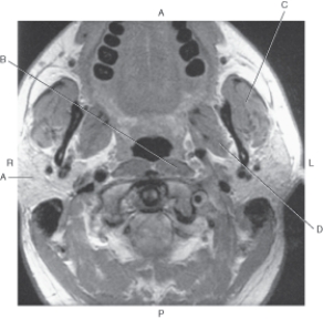In the figure below of an axial MR of the neck,which arrow points to the medial pterygoid muscle?   A)  A B)  B C)  C D)  D