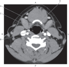 Refer to the figure below of an axial CT of the neck.    -Which arrow points to the submandibular gland? A)  A B)  B C)  C D)  D