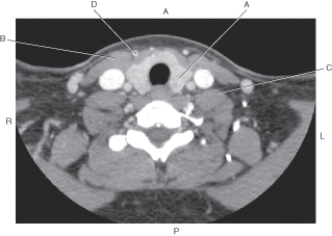 Refer to the figure below of an axial CT of the neck.    -Which arrow points to the SCM? A)  A B)  B C)  C D)  D