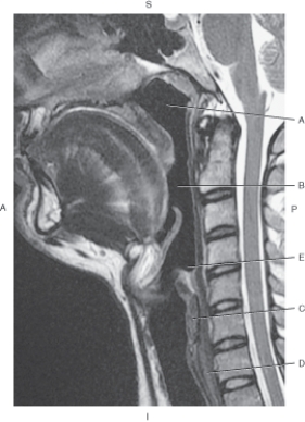 Refer to the figure below of a midsagittal, T2-weighted MRI of pharyngeal divisions.    -Which arrow points to the oropharynx? A)  A B)  B C)  C D)  D E)  E