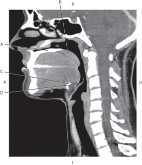 Refer to the figure below of a sagittal CT reformat of the pharynx.    -Which arrow points to the epiglottis? A)  A B)  B C)  C D)  D