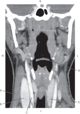 Refer to the figure below of a coronal CT reformat of the neck.    -Which arrow points to the thyroid gland? A)  A B)  B C)  C D)  D E)  E