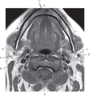 Refer to the figure below of an axial, T1-weighted MRI of the sublingual glands.    -Which arrow points to the internal jugular vein? A)  A B)  B C)  C D)  D