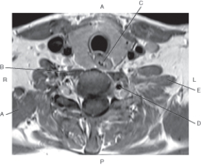Refer to the figure below of an axial, T1-weighted MRI of the neck.    -Which arrow points to the middle scalene muscle? A)  A B)  B C)  C D)  D E)  E