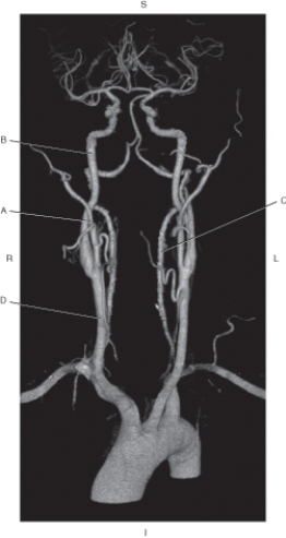 Refer to the figure below of a CTA of intracranial and extracranial arteries.    -Which arrow points to the internal carotid artery? A)  A B)  B C)  C D)  D