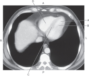 In the figure below of an axial CT of heart with pericardium,which arrow points to the epicardial fat?   A)  A B)  B C)  C D)  D