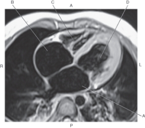In the figure below of an axial,T1-weighted MRI with four-chamber view of heart,which arrow points to the right atrium?   A)  A B)  B C)  C D)  D