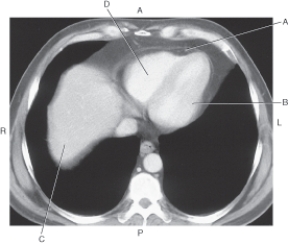 In the figure below of an axial CT of heart with pericardium,which arrow points to the right ventricle?   A)  A B)  B C)  C D)  D