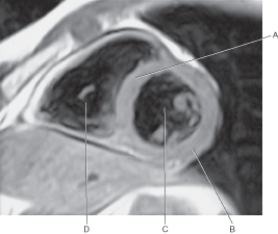 In the figure below of a short-axis MR of the heart,which arrow points to the left ventricle?   A)  A B)  B C)  C D)  D