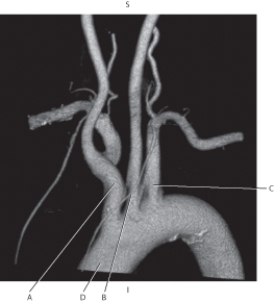 Refer to the figure below of a 3D CT of the aortic arch.    -Which arrow points to ascending aorta? A)  A B)  B C)  C D)  D