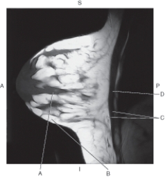 In the figure below an a sagittal MR of the breast,which arrow points to the glandular tissue?   A)  A B)  B C)  C D)  D