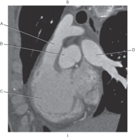 Refer to the figure below of an RVOT CT.    -Which arrow points to the root of the aorta? A)  A B)  B C)  C D)  D