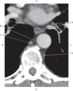 Refer to the figure below.    -Which arrow points to the hemiazygos vein? A)  A B)  B C)  C D)  D
