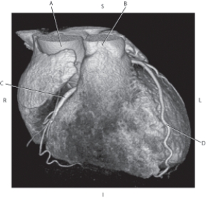 Refer to the figure below.    -Which arrow points to the right coronary artery? A)  A B)  B C)  C D)  D